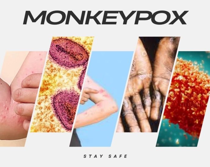 Monkeypox