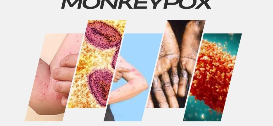 Monkeypox